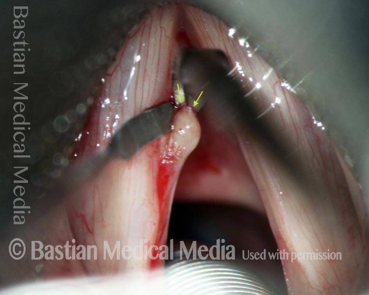 Removal of cyst
