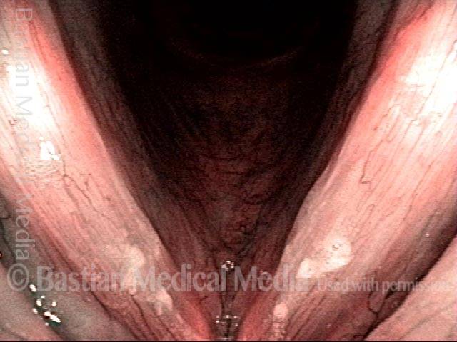 Vocal cord bruise / hemorrhage, after rest and surgery