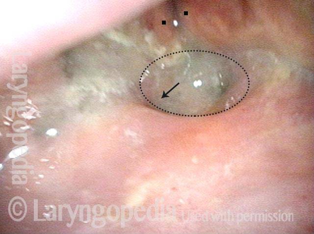 surgically-minimized laryngeal vestibule