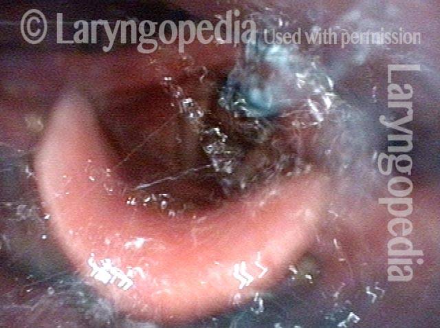 Cough expels the water from airway