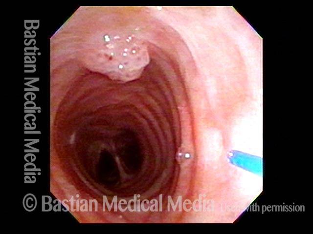 Mid-tracheal papilloma, being treated by thulium laser