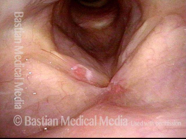 Vocal cord ulcer