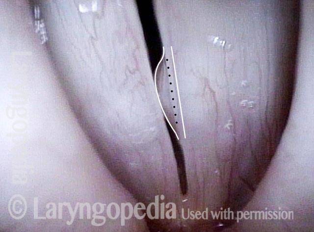 incision line options for planned dissection and removal of this cyst
