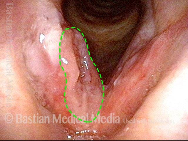 vocal cord carcinoma