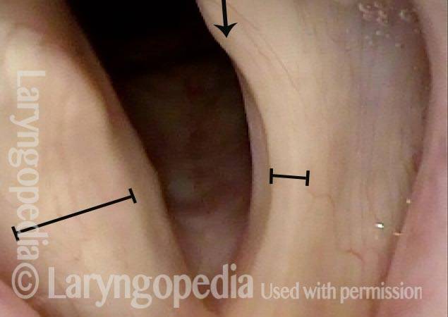 Post carotid endarterectomy