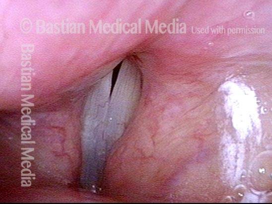 Vocal cord paralysis: 5 months after medialization