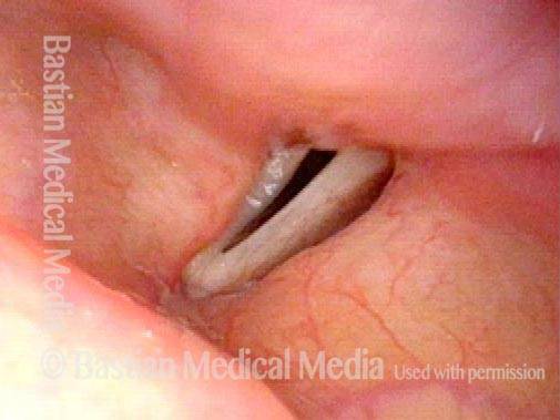 Vocal cord paralysis: before medialization