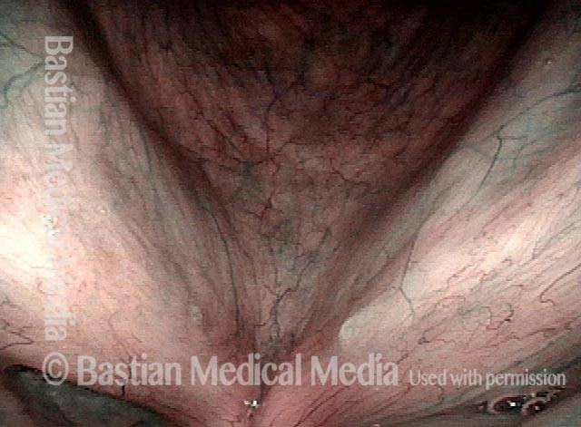 no stippled or other abnormal vascular marks