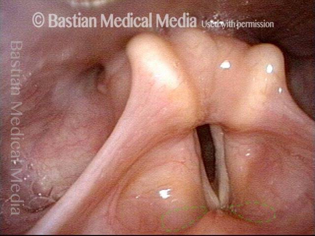 Bilateral laryngocele