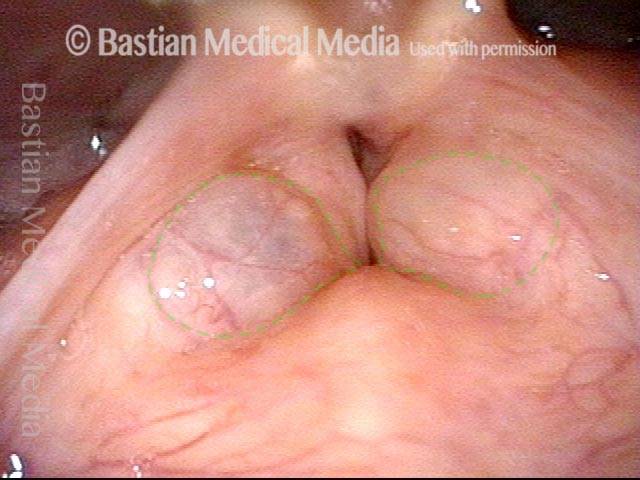 Bilateral laryngocele
