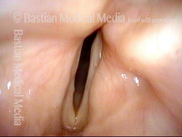 Bilateral laryngocele, after removal