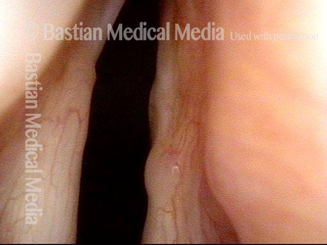 Bilateral laryngocele, after removal