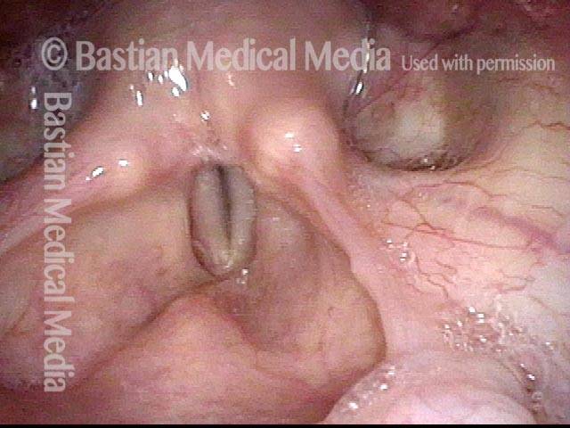 vocal cords appear to come together