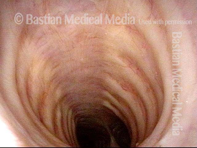 Mid-distal trachea