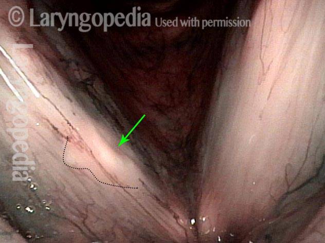 Cyst under narrow band light