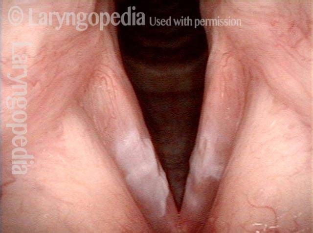 Ulcerative laryngitis
