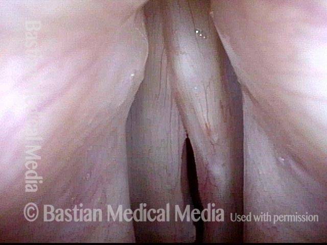 Vocal cord scissoring, made more obvious by atrophy