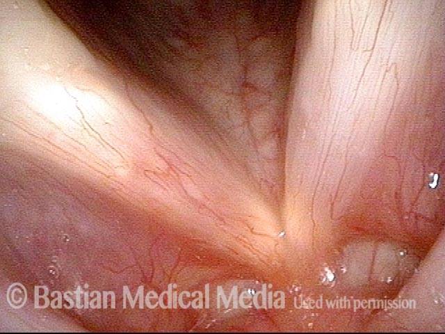 Epidermoid cyst, removed