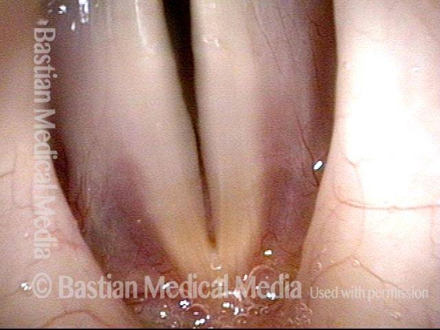 Vocal polyp, surgically removed