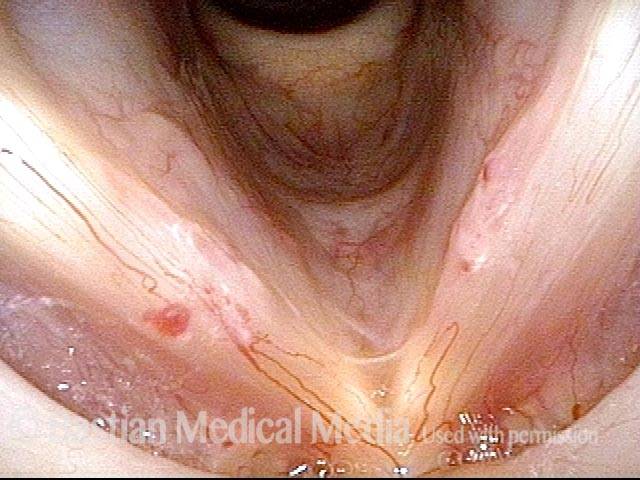 Capillary ectasia with vocal nodules (1 of 2)