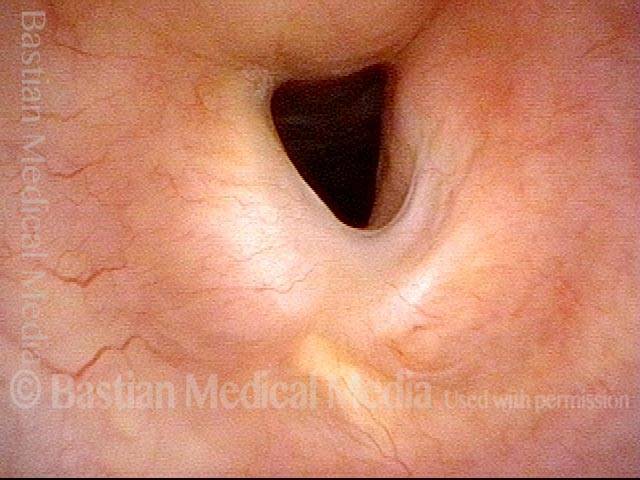 Tracheal stenosis