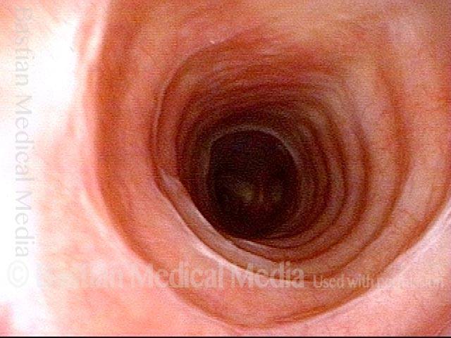 Just below the tracheal stenosis