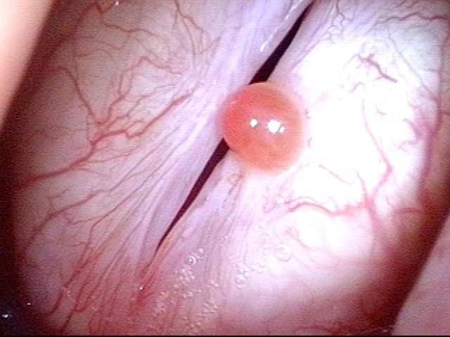 closer view of granuloma
