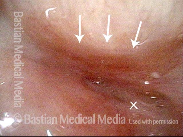 Tracheal stenosis and collapse