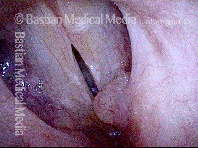 Anterior saccular cyst
