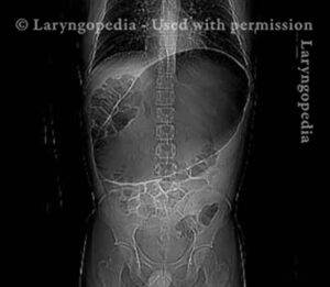 X-Ray of Abdominal Bloating