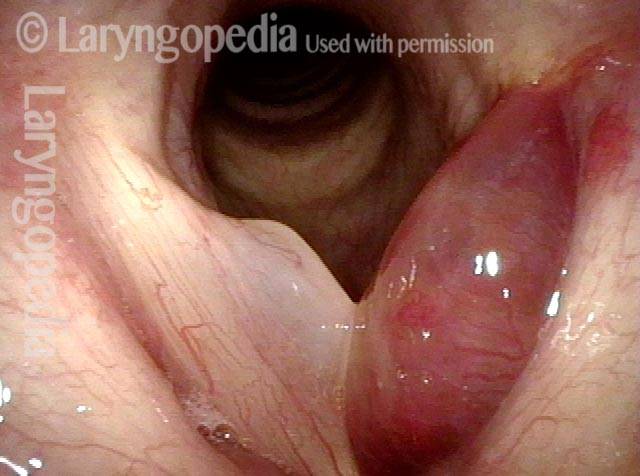 Bruising of left vocal cord