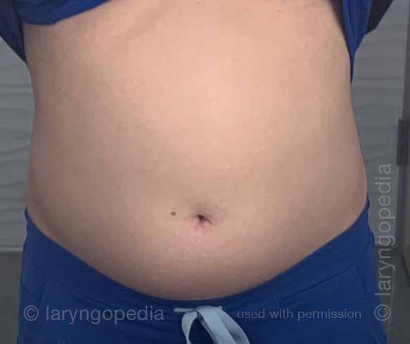 front view of bloating stomach