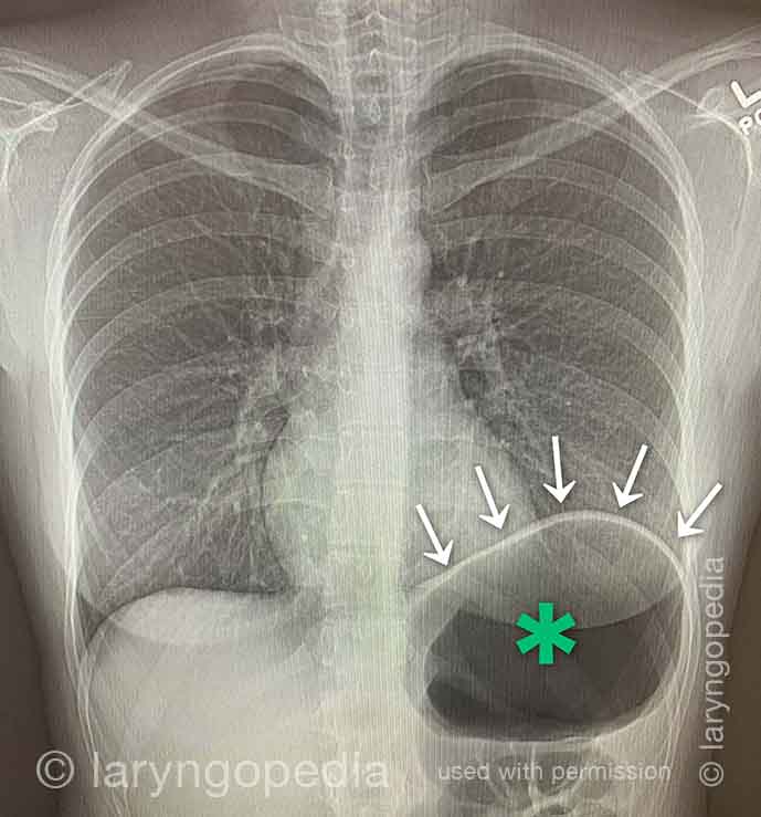 X-ray of trapped air