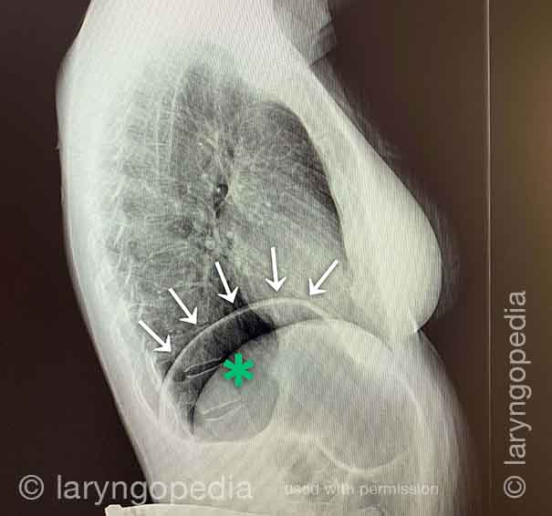 x-ray of side view