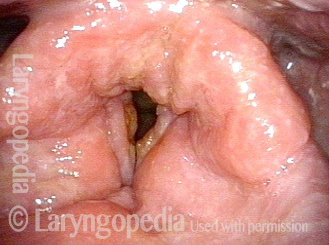 Vocal cords of a Heavy smoker