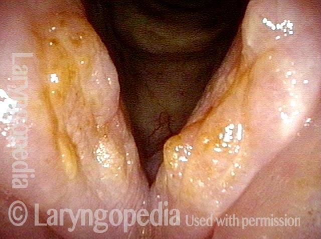 Closer view of vocal cords