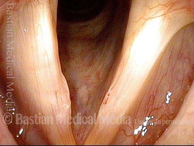 Capillary ectasia with vocal nodules