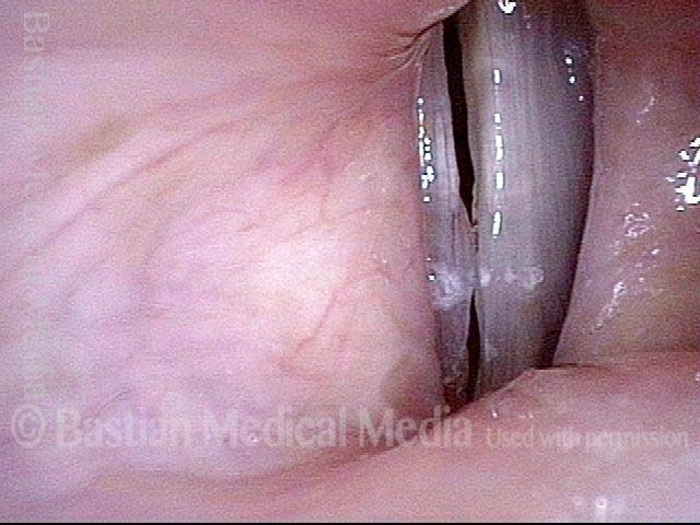 Capillary ectasia with vocal nodules