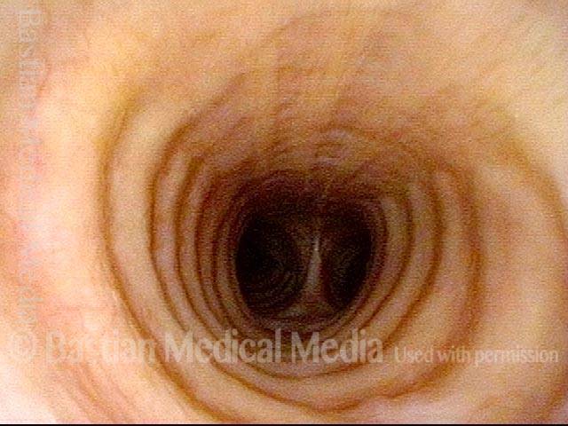 Just below the tracheal stenosis
