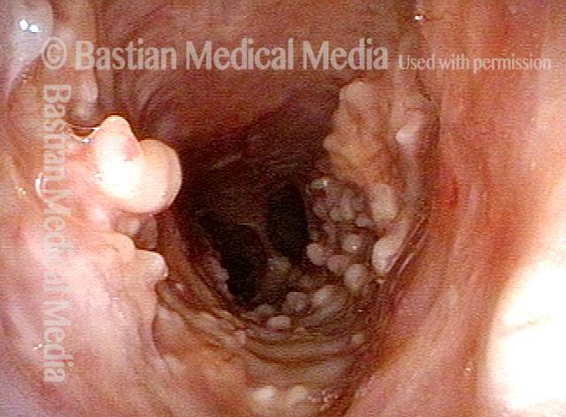 View into mid-trachea, diagnosis unknown