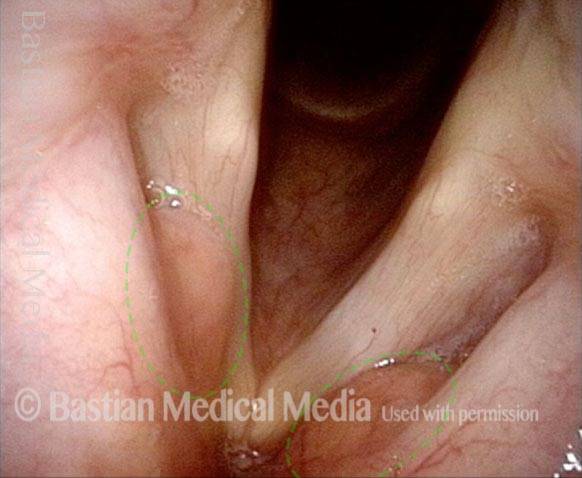 Bilateral anterior saccular cysts