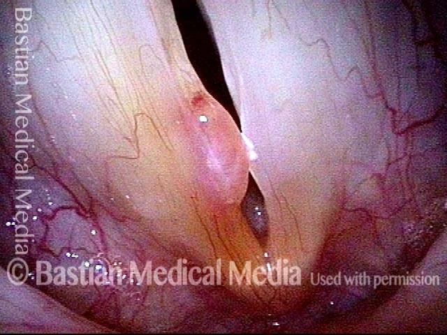 Vocal polyp, subsequent new injury