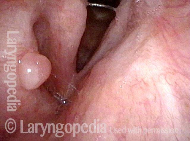 Obvious lesion not important