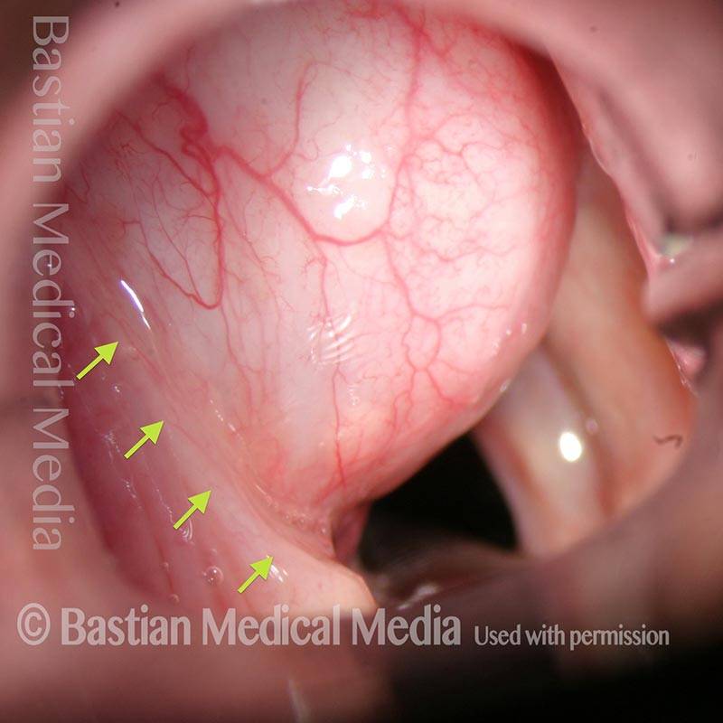 Lateral saccular cyst removal, endoscopic approach