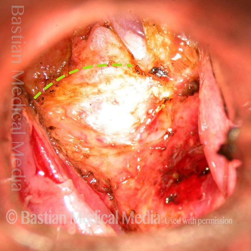 Lateral saccular cyst removal, endoscopic approach
