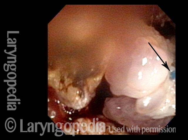 Removal of papilloma