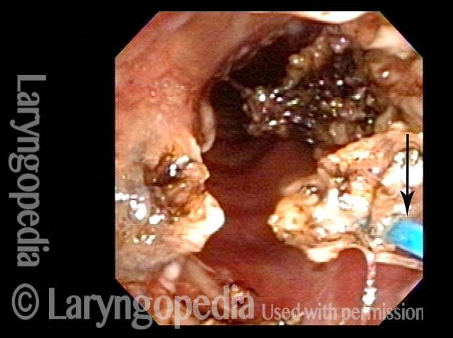 Improved breathing with papilloma removal