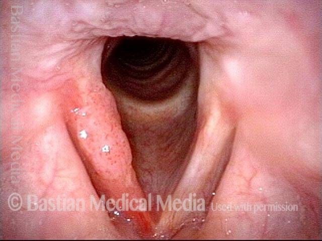Papillomas: HPV Subtype 18 or 45