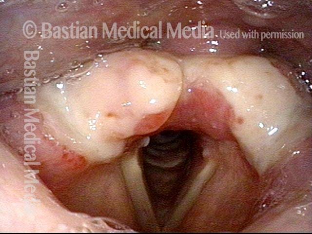 mucosa from the postarytenoid surface