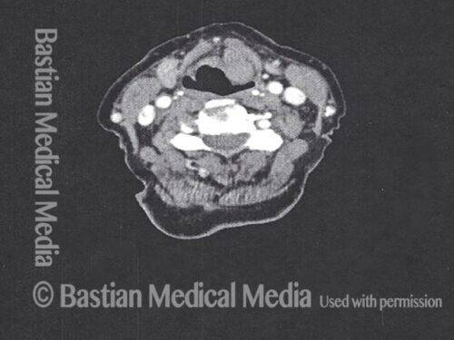 Saccular Cyst - Laryngopedia